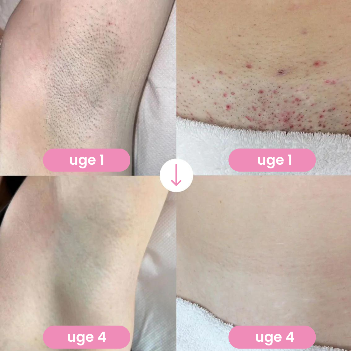 IPL PRO - Laser hårfjerner